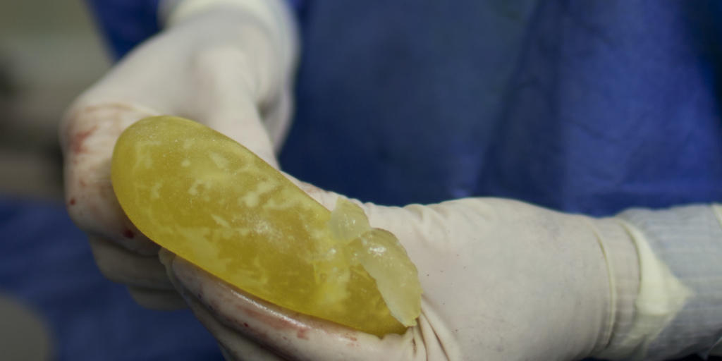 Eines der beschädigten Brustimplantate. Die französische Firma PIP hatte die Implantate statt mit Spezial-Silikon mit billigerem Industrie-Silikon befüllt. Die Kissen reissen leichter und können Entzündungen auslösen. (Archivbild)