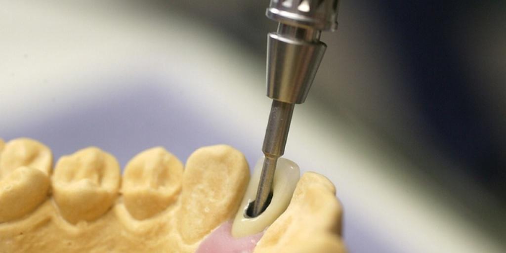 Für Dentalimplantate sind die USA der grösste Markt. Dementsprechend zeigte sich Straumann über das Gerichtsurteil erfreut. (Archiv) Für Dentalimplantate sind die USA der grösste Markt. Dementsprechend zeigte sich Straumann über das Gerichtsurteil erfreut. (Archiv)